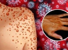 Mỹ đưa ra tuyên bố khẩn cấp về dịch bệnh đậu mùa khỉ là tình trạng sức khỏe cộng đồng!